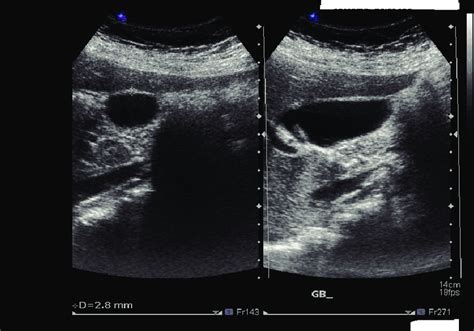 normal gallbladder wall thickness measurement|gallbladder wall thickness on ultrasound.